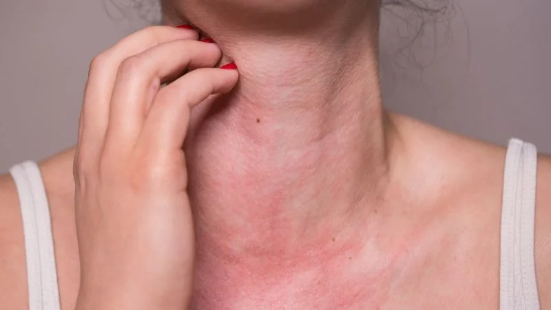 Close-up of allergic reaction to silicone product